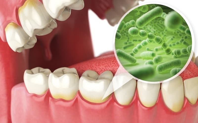 Cao vôi răng là gì?