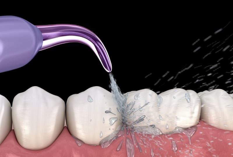 Lấy cao răng bằng phương pháp Air-Flow