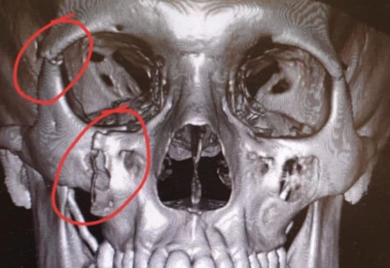 điều trị gãy xương gò má