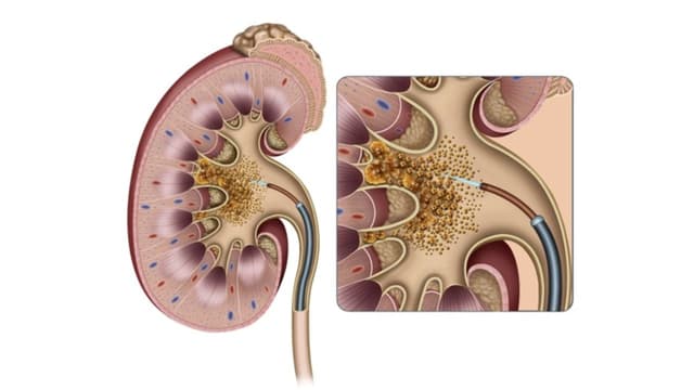 Chi phí tán sỏi thận ống mềm có giá bao nhiêu tiền?