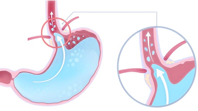 Lý giải nguyên nhân dịch dạ dày trào ngược vào thực quản