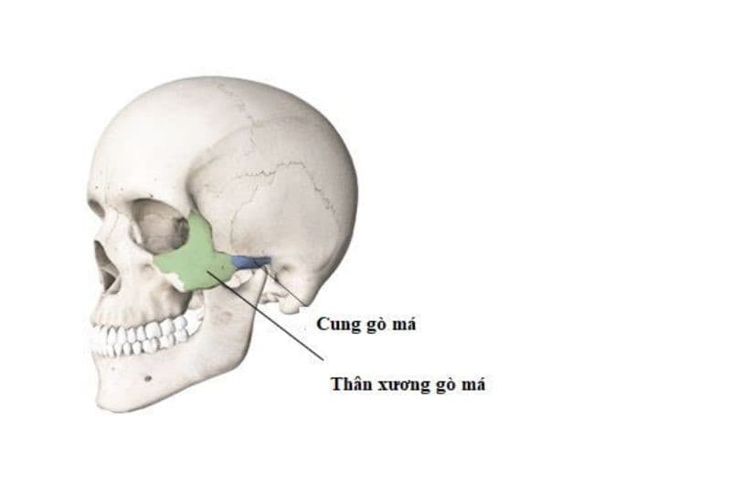 gãy xương gò má là gì? 