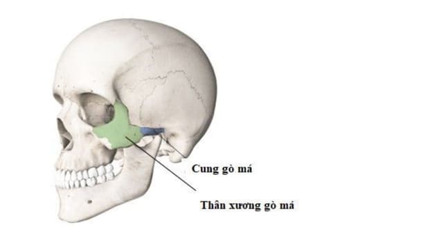 Nhận diện gãy xương gò má và cách xử trí