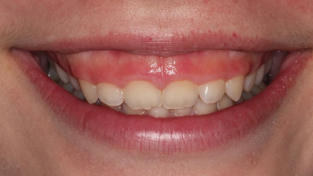 Mức giá phẫu thuật cắt lợi dành cho ai muốn biết