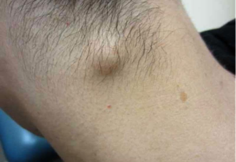 mẹo chữa u bã đậu