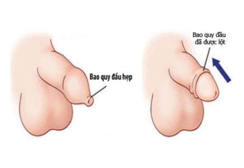 hẹp bao quy đầu ở trẻ em