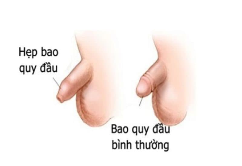 nguyên nhân gây hẹp bao quy đầu và cách điều trị 