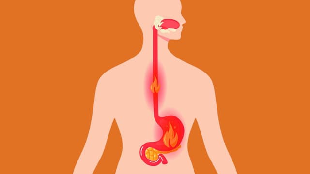 Nguyên nhân gây nóng rát thực quản: Hiểu rõ để điều trị hiệu quả