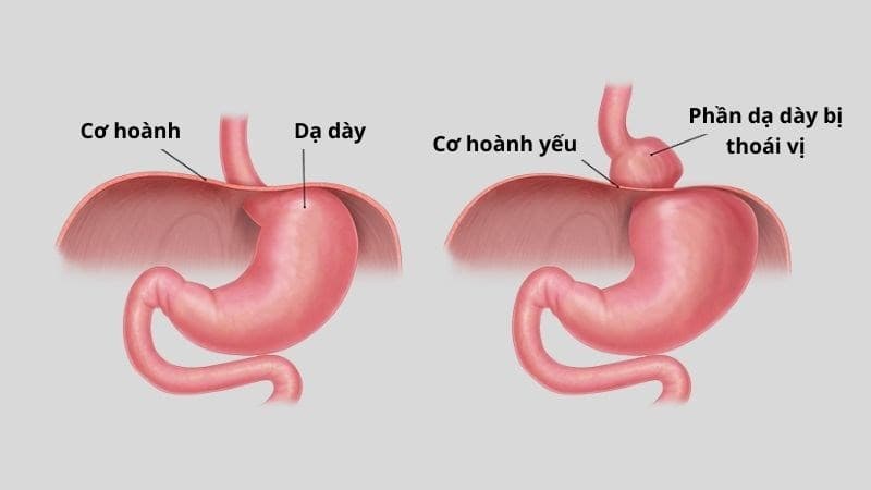 Thoát vị cơ hoành là tình trạng mà một phần của dạ dày bị đẩy lên qua cơ hoành, làm suy yếu cơ vòng thực quản dưới và gây trào ngược