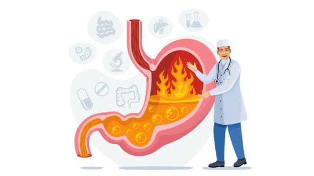 Cách ngăn ngừa ợ nóng trào ngược dạ dày tái phát sau điều trị