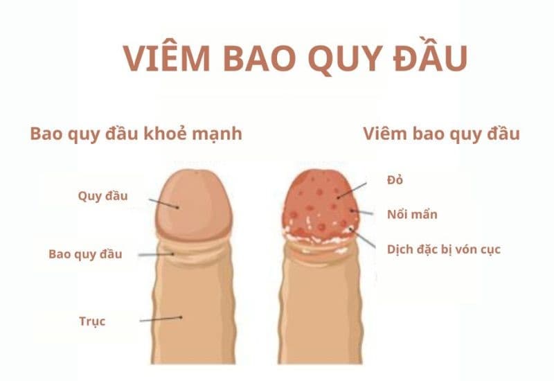 nguyên nhân hẹp bao quy đầu do bệnh lý gây viêm 