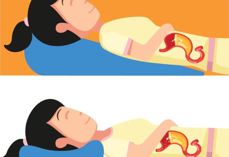 Thay đổi lối sống giúp ngăn ngừa ợ nóng trào ngược dạ dày tái phát