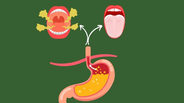 Mùi hôi miệng và lưỡi trắng: Ảnh hưởng của trào ngược dạ dày