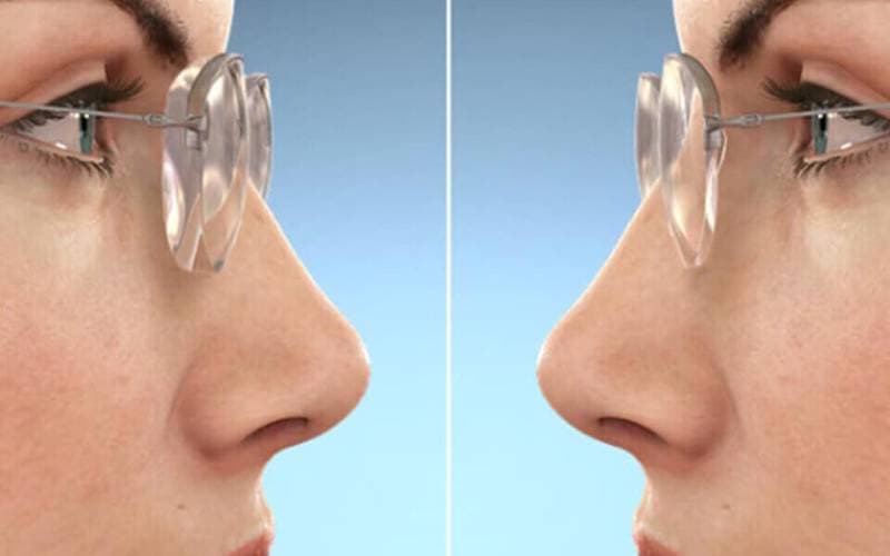 Cắt mắt kính cận mỏng đắt không