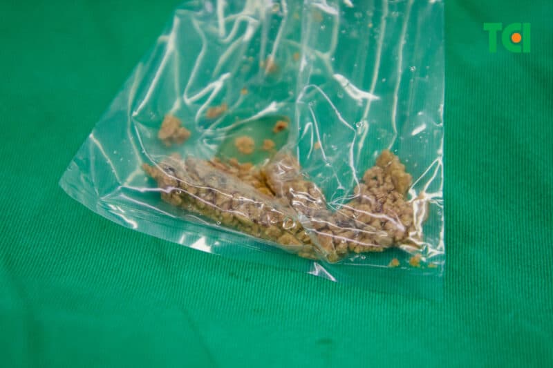 Nội soi tán sỏi thận qua da đường hầm siêu nhỏ có hiệu quả không?