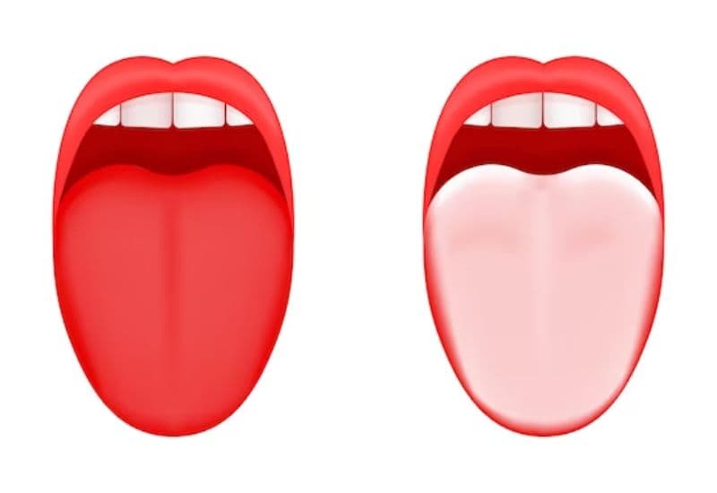 Lưỡi trắng do ảnh hưởng của trào ngược dạ dày