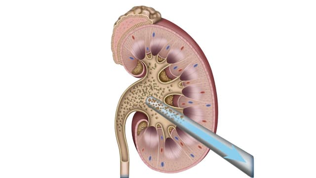 Thế nào là nội soi tán sỏi thận qua da đường hầm siêu nhỏ?