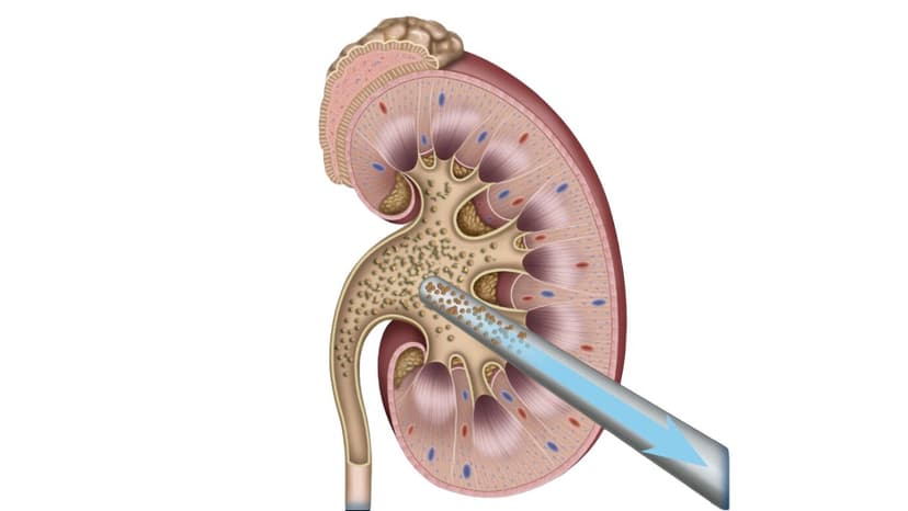 Thế nào là nội soi tán sỏi thận qua da đường hầm siêu nhỏ?