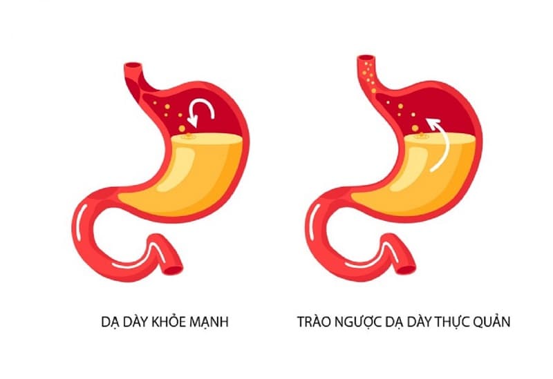 Nguyên nhân gây buồn nôn ợ nóng