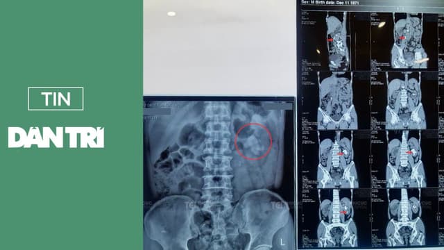 Phối hợp 3 kỹ thuật hiện đại điều trị thành công sỏi tiết niệu đa vị trí