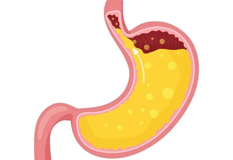 Dạ dày trào ngược là gì?