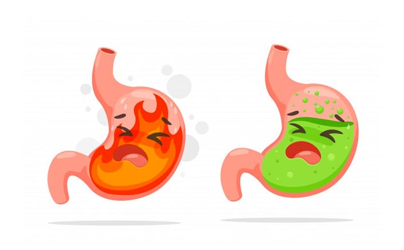 Trào ngược dạ dày là gì?