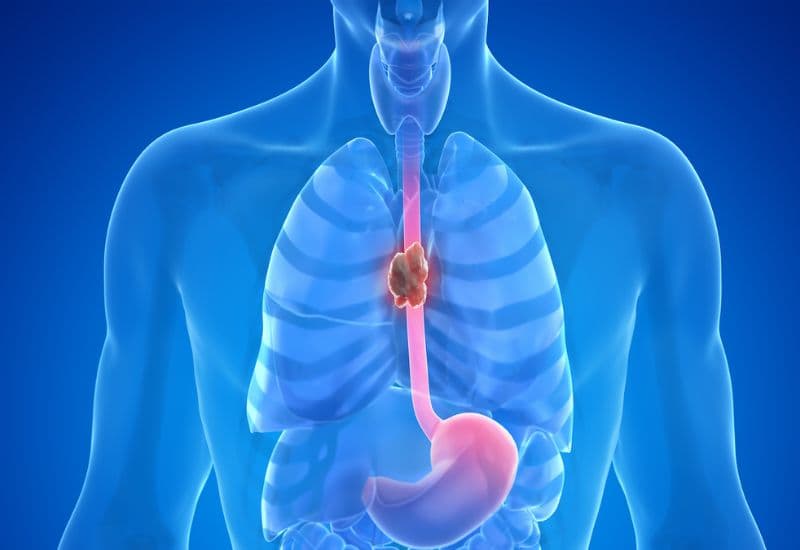 Đầy hơi, ợ hơi liên tục có thể là dấu hiệu bệnh ung thư đường tiêu hóa