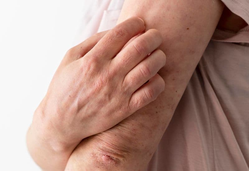 Người bị bệnh về máu hoặc đang sử dụng thuốc chống đông máu cần được tiêm ở vị trí có ít mạch máu; người có vấn đề về da tại một vùng cơ thể cụ thể sẽ được chuyên gia y tế cân nhắc chọn vị trí tiêm khác để tránh biến chứng.