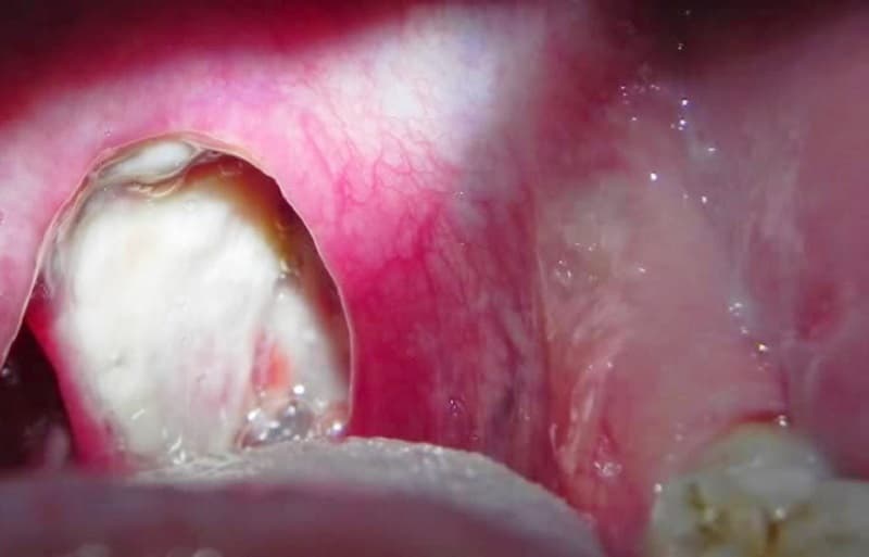 Hình ảnh viêm xoang mũi