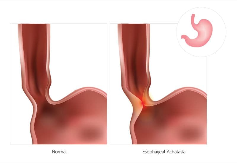 Các nguyên nhân khác gây nuốt đau ở thực quản