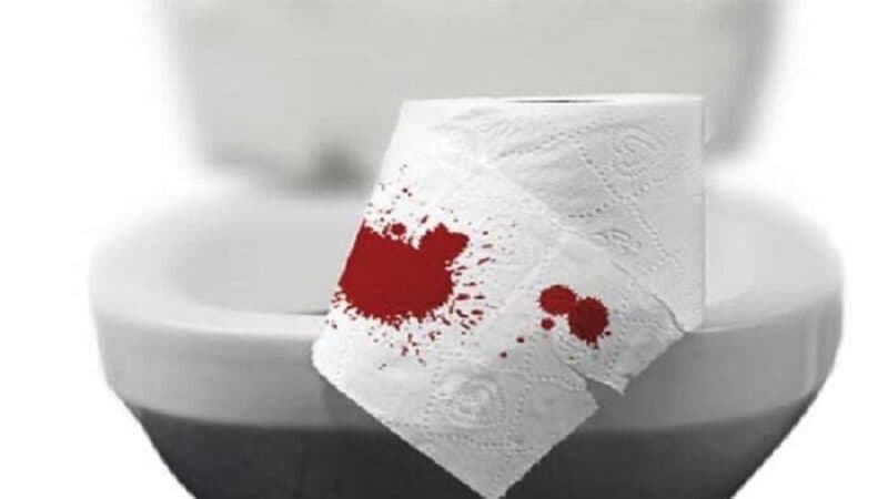 Chảy máu hậu môn là triệu chứng điển hình của bệnh trĩ nội