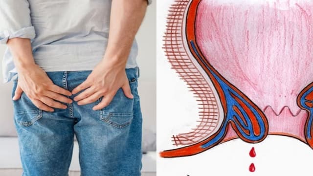 Cẩn trọng với các biến chứng trĩ nội