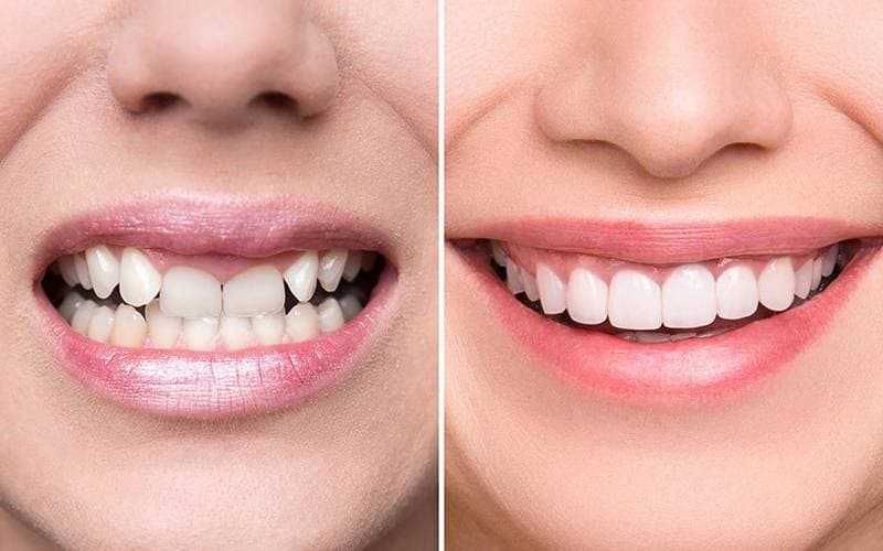 Bọc răng sứ 2 hàm giá bao nhiêu tại TCI