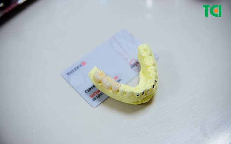 Bọc răng sứ 2 hàm giá bao nhiêu hiện nay