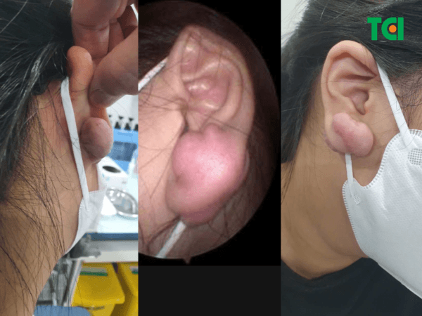 bump lỗ xỏ khuyên