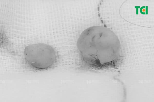 Không ít ca đến TCI là bump lỗ xỏ khuyên dái tai.