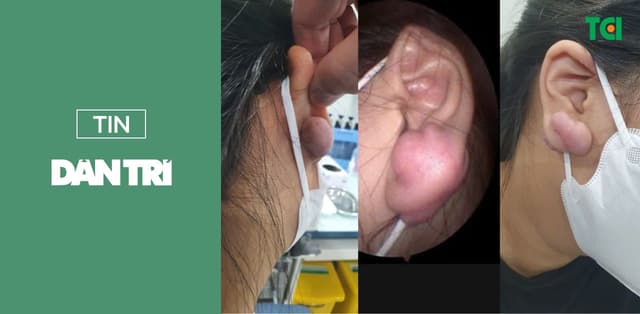 Bump lỗ xỏ khuyên: Cẩn trọng nguy cơ biến dạng tai nghiêm trọng