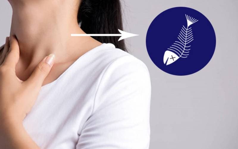 Cách trị khi bị hóc xương cá bằng cách nào