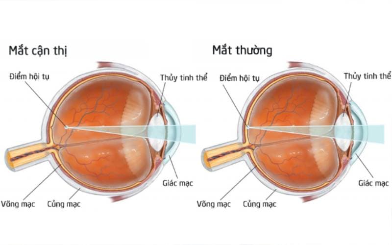 Cắt kính cận lấy liền được không