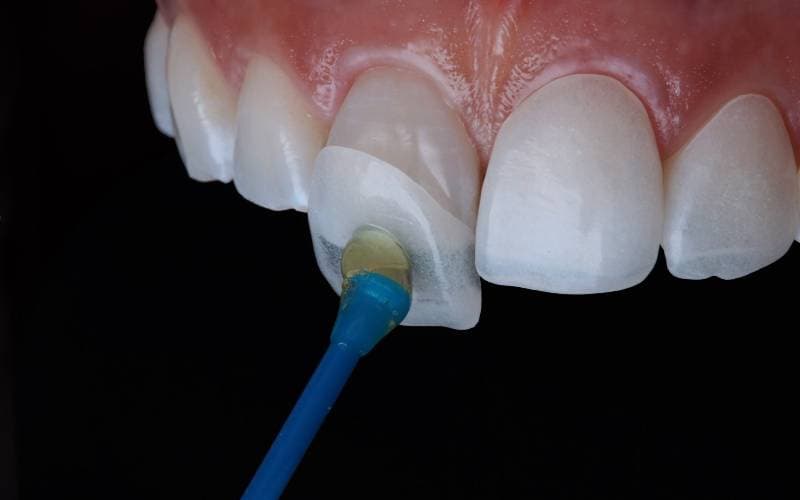 Dán sứ veneer giá bao nhiêu