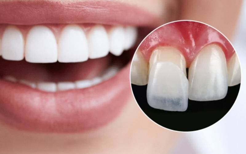 Dán sứ veneer giá bao tiền