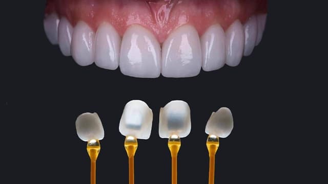 Dán sứ veneer Hà Nội – Quy trình chung và những điều cần lưu ý