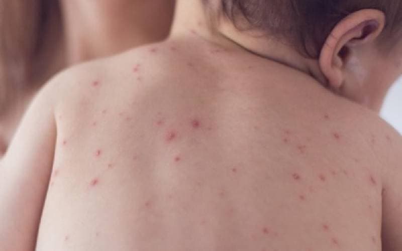 Tìm Dấu hiệu của thủy đậu