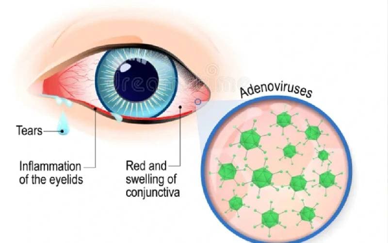 tư vấn đau mắt đỏ triệu chứng thế nào