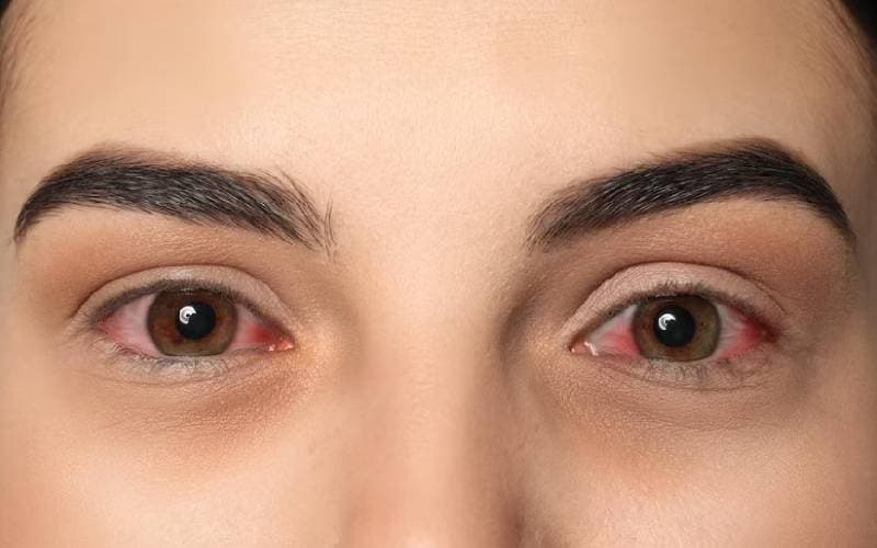 Đau mắt đỏ triệu chứng thế nào nhận biết 