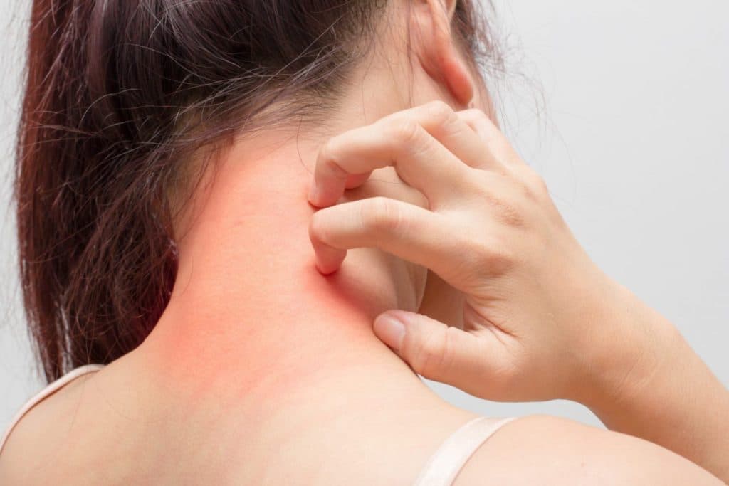 dị ứng sau tiêm vacxin