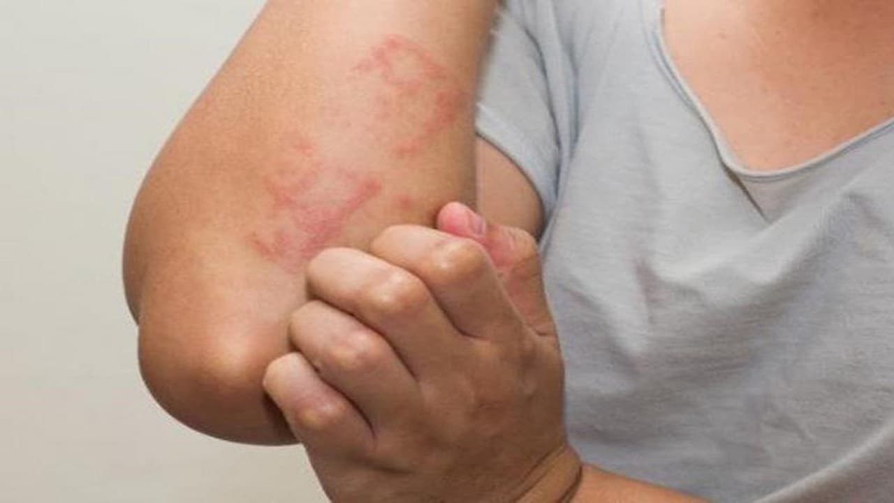 Mặc dù vắc xin đóng vai trò quan trọng nhưng một số đối tượng không được tiêm vacxin theo khuyến cáo của Bộ Y tế