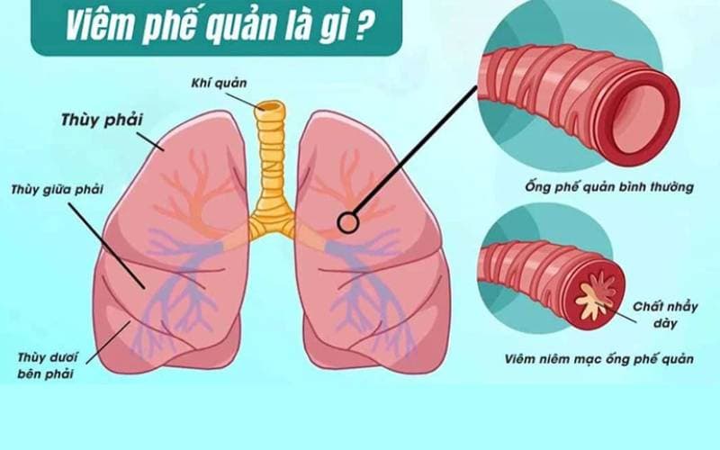 Hình ảnh viêm phế quản dấu hiệu