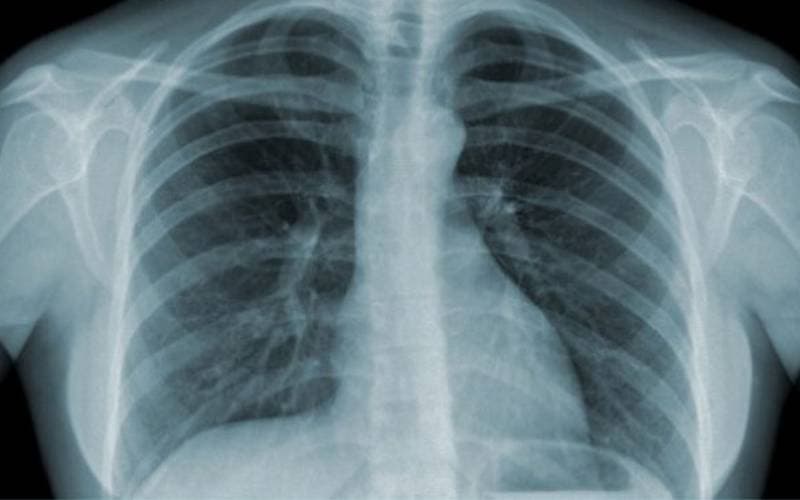 Thực tế Hình ảnh viêm phế quản