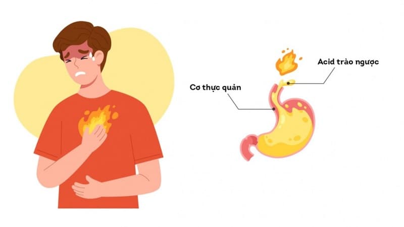 Nguyên nhân gây ợ chua nóng cổ